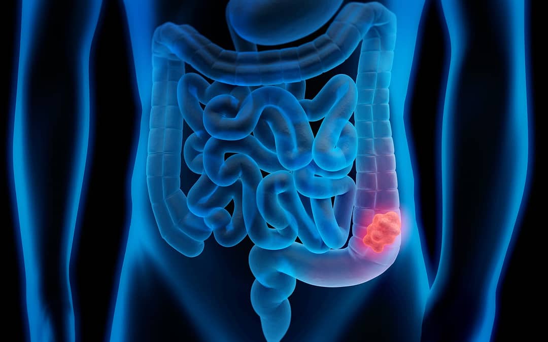 Confusion Over Colon Cancer Syndromes Leads to Wrong Testing