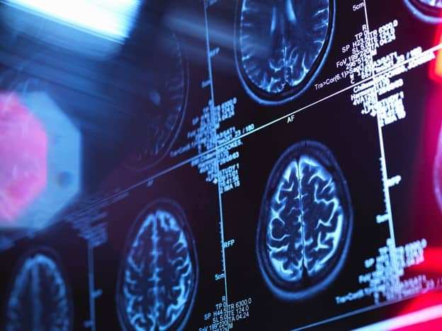 My Gene Counsel Offers Personalized Genetic Counseling Reports for Those With Positive Alzheimer’s Gene Test Result