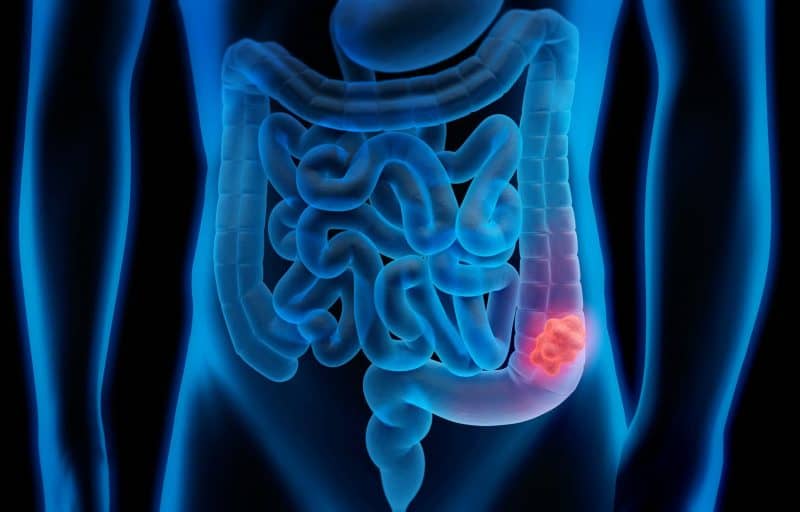 Confusion Over Colon Cancer Syndromes Leads to Wrong Testing